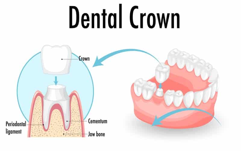 How Long Do Dental Crowns Last?