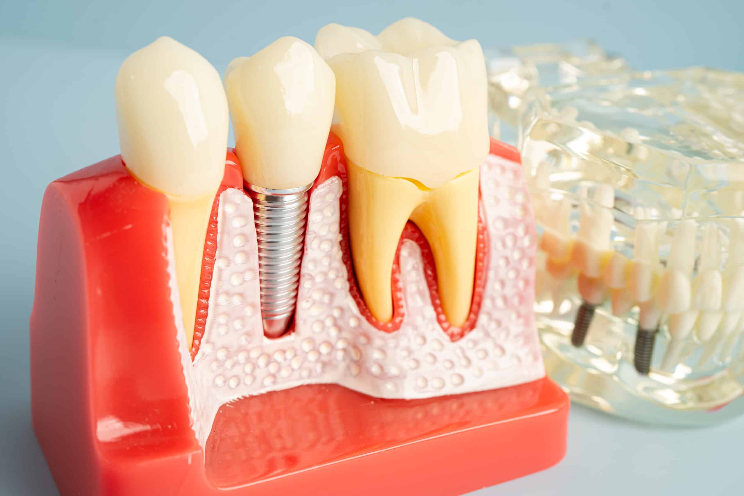 How Much Time Do Dental Implants Take? A Step By Step Timeline