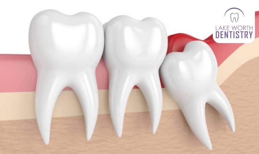 Preparation For Multiple Tooth Extraction