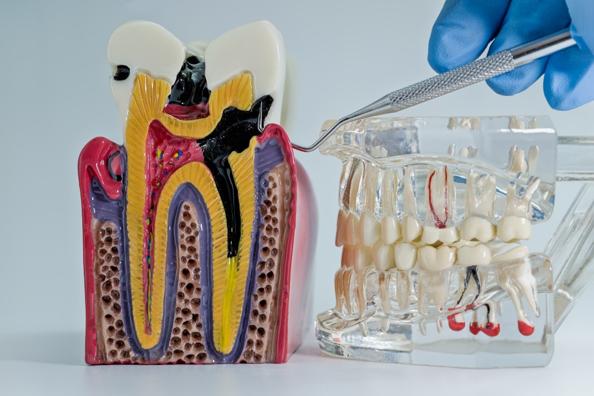 How Does A Root Canal Differ For Front Teeth Vs Molars?