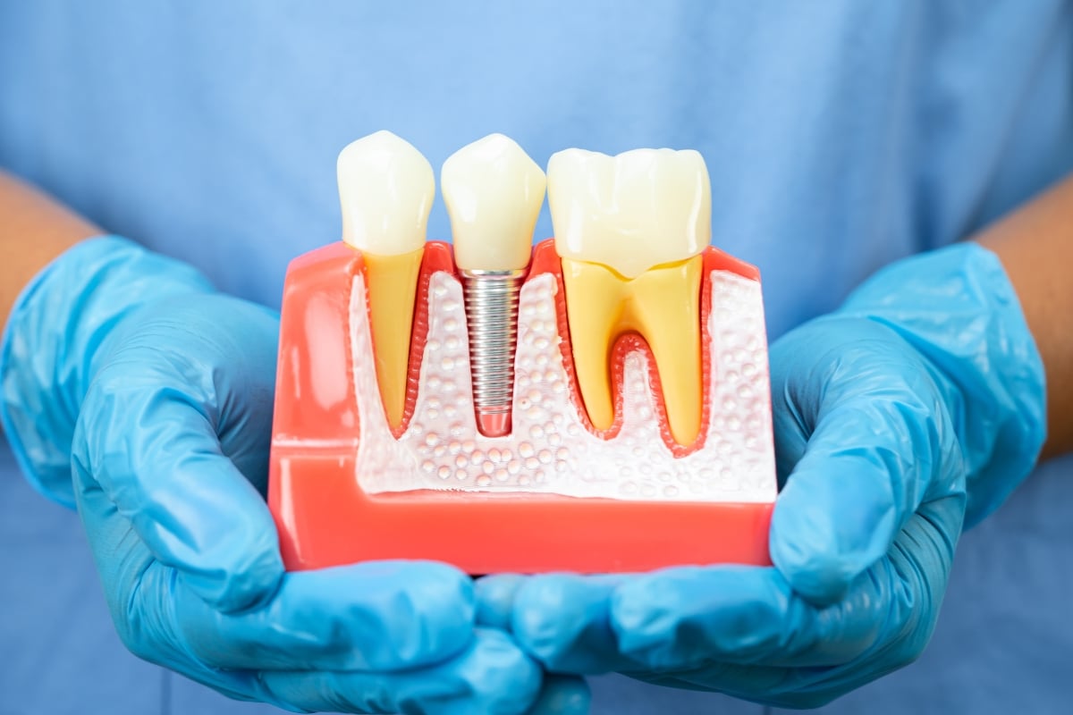 Tooth Removal And Dental Implants Explained: Is It Right For You?