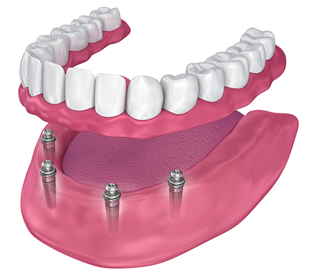Greenacres All-on-4 Implants