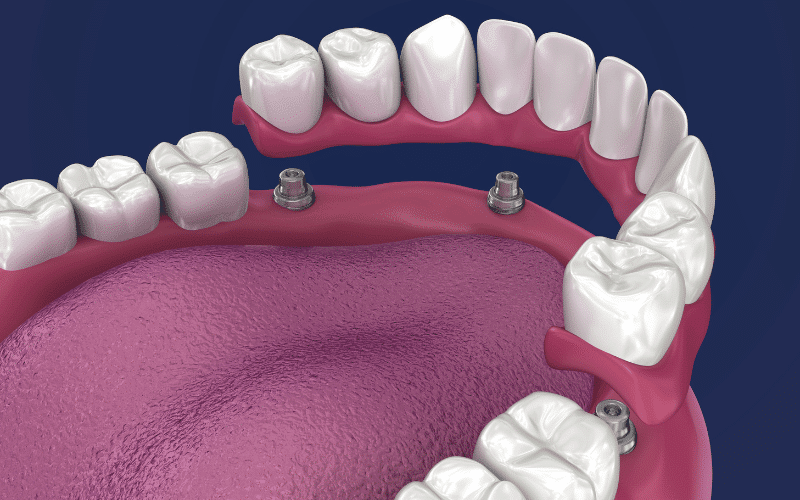 How Long Do All On   Implants Last?