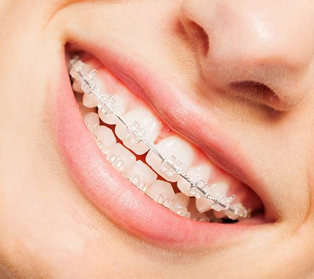Greenacres Clear Braces
