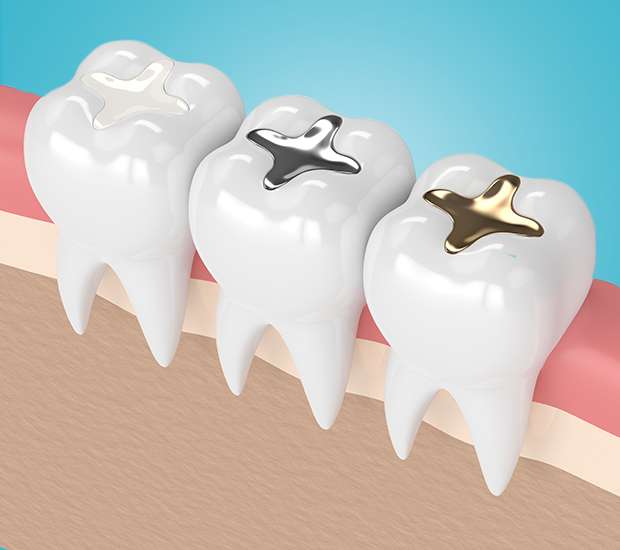 Greenacres Composite Fillings