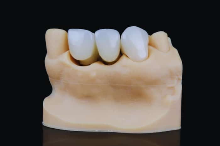 Debunking Common Myths About Dental Bridges