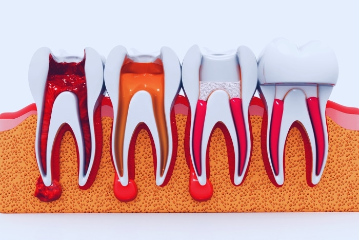 Debunking The Myth Of Root Canal Pain: What You Need To Know