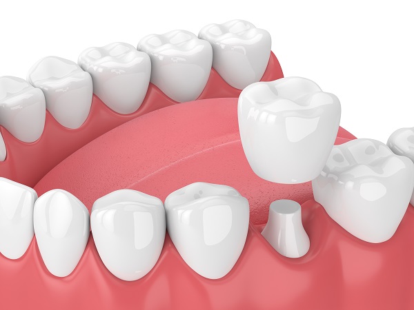 The Benefits Of Dental Crowns For Your Oral Health