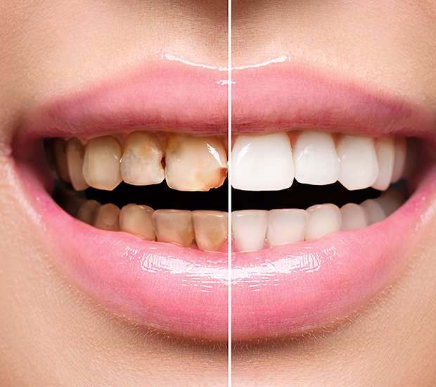 Greenacres Dental Implant Restoration