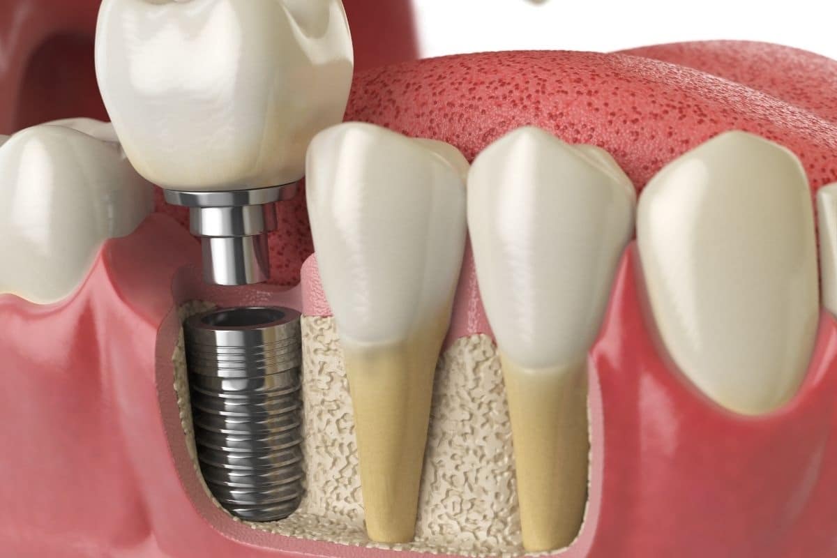 Dental Implant Abutments Explained: A Comprehensive Overview