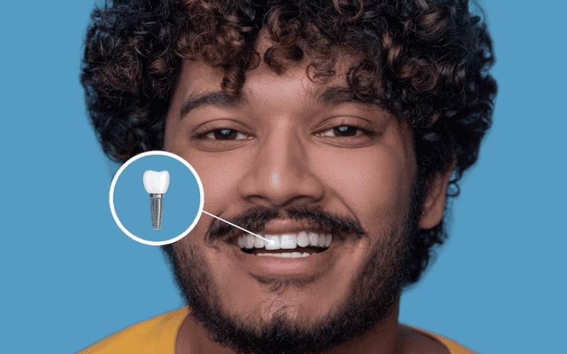 How Long Can Dental Implants Last?