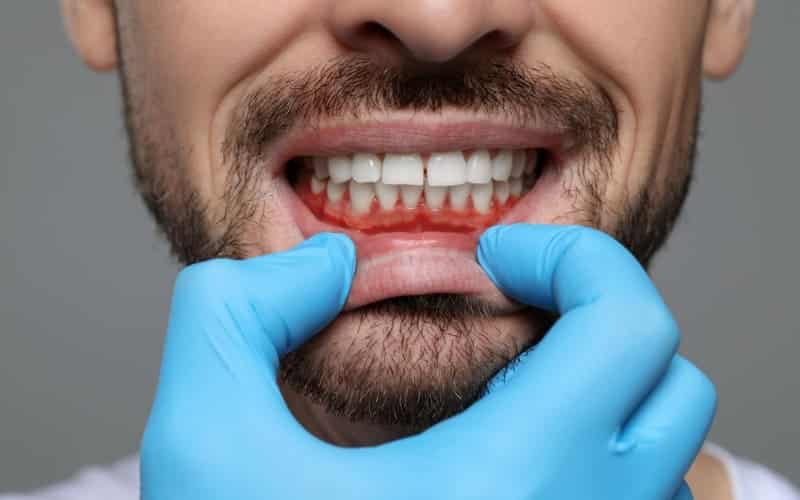 Can You Get Dentures With Receding Gums?
