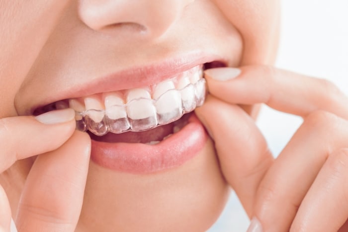 Does Invisalign Work? Advantages, Disadvantages, And Effectiveness