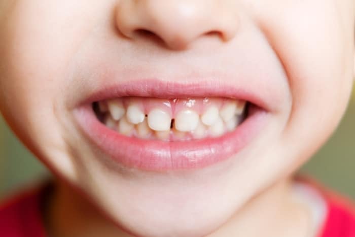 Caring For Your Kid’s Teeth In Lake Worth: Unique Challenges And Tips
