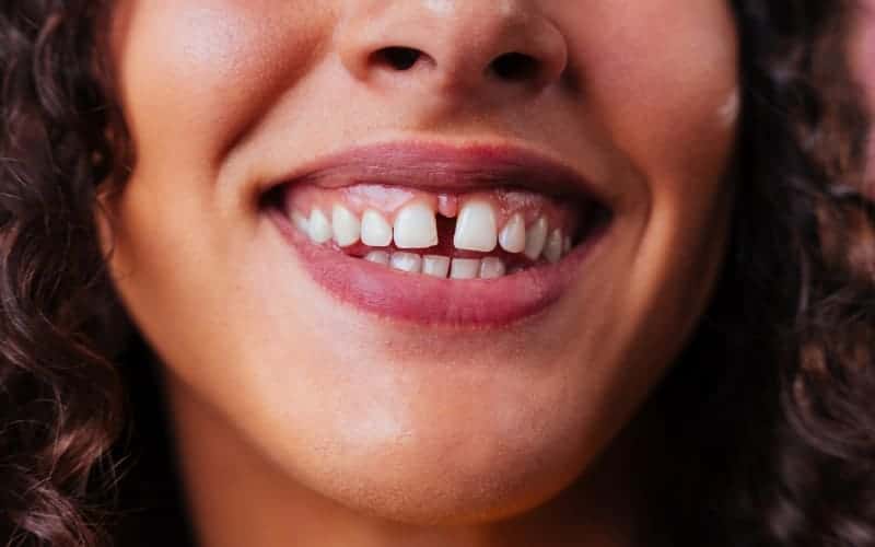 How To Fill Gaps Between Teeth?