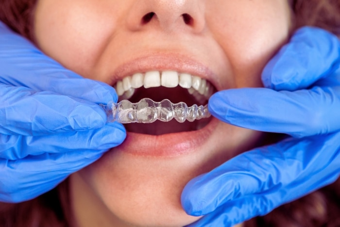 How Can Invisalign Transform Your Life Beyond A Beautiful Smile?
