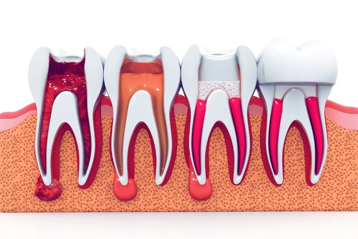 Root Canal Explained: What It Treats, How It Works, And Recovery Tips