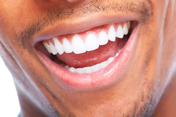 Popular Options For A Stained Teeth Smile Makeover