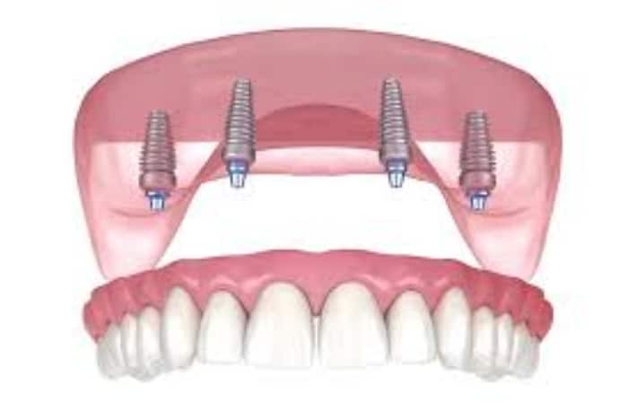 Tired Of Soft Foods? All On   Implants Let You Eat Anything Again